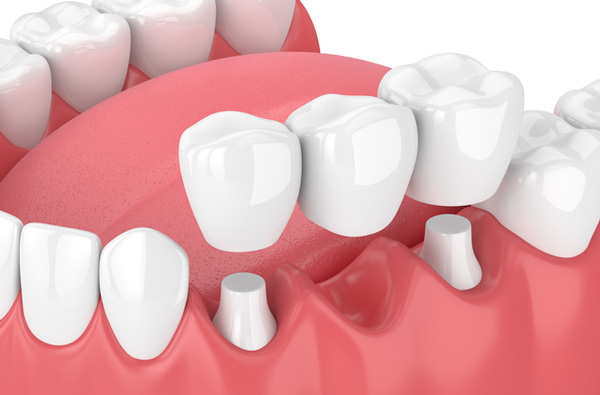 Dental Bridge at Cramer Dental