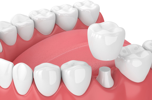 Dental Crown at Cramer Dental