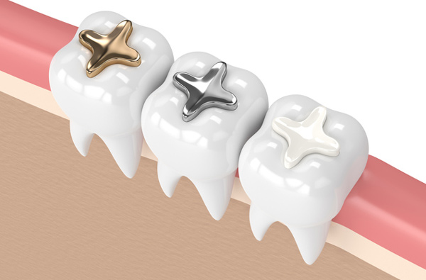 Dental Filling at Cramer Dental