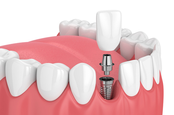 Dental Implant at Cramer Dental