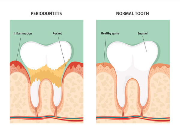 Periodontal Care at Cramer Dental