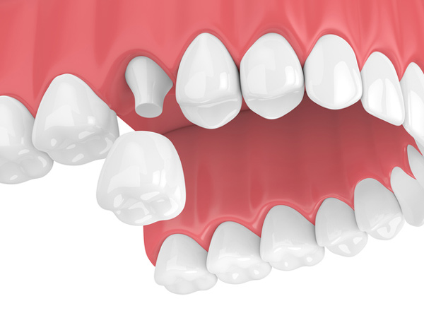 Porcelain Crowns at Cramer Dental