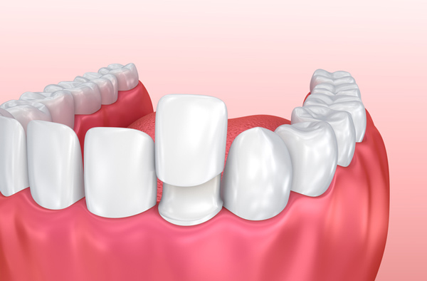Dental Veneers at Cramer Dental