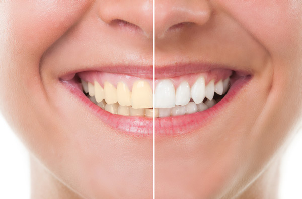 Teeth Whitening at Cramer Dental